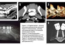 Lumbosacral stabilisation in a Rottweiler dog